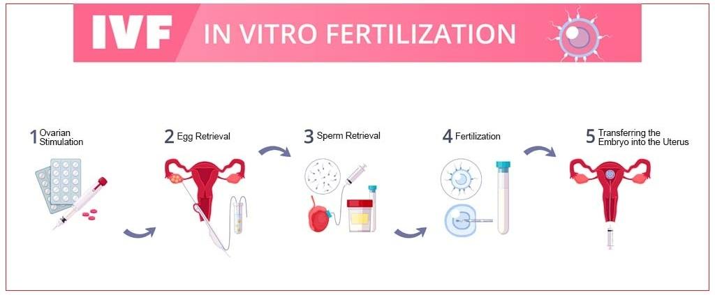 five Stages of IVF