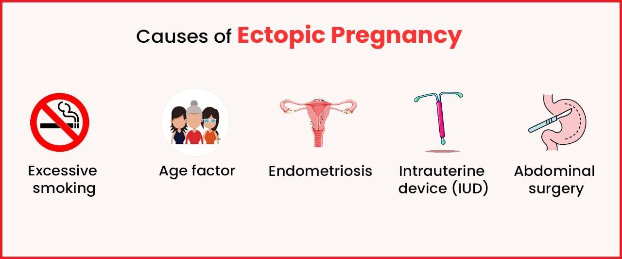 View of Ectopic Pregnancy - Causes, Symptoms & Treatments