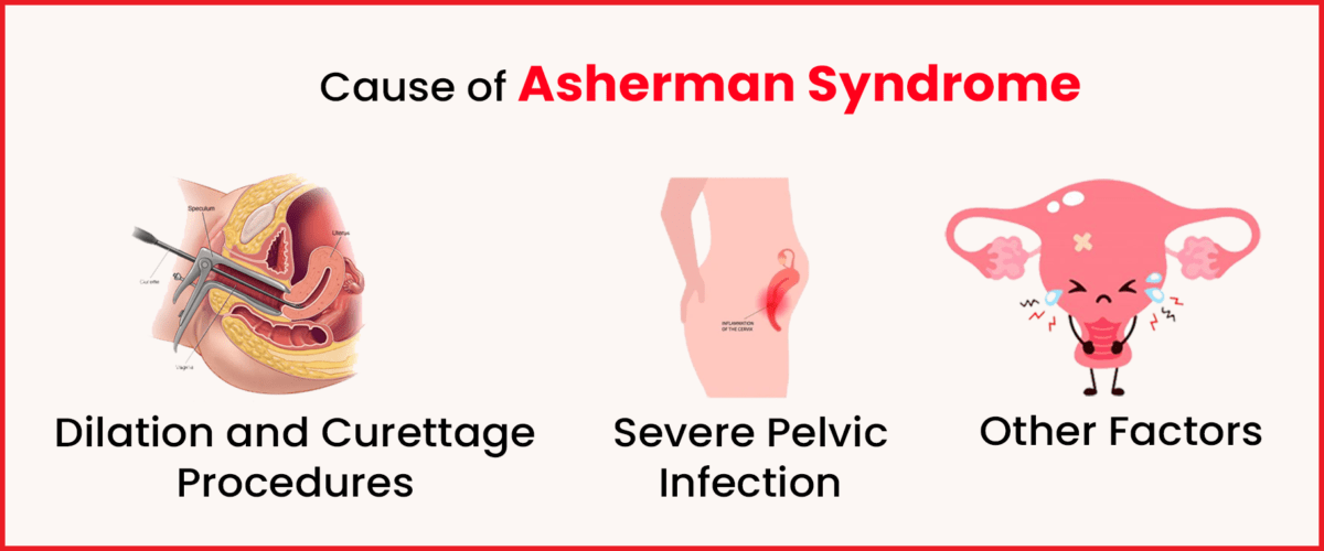 Asherman Syndrome Causes