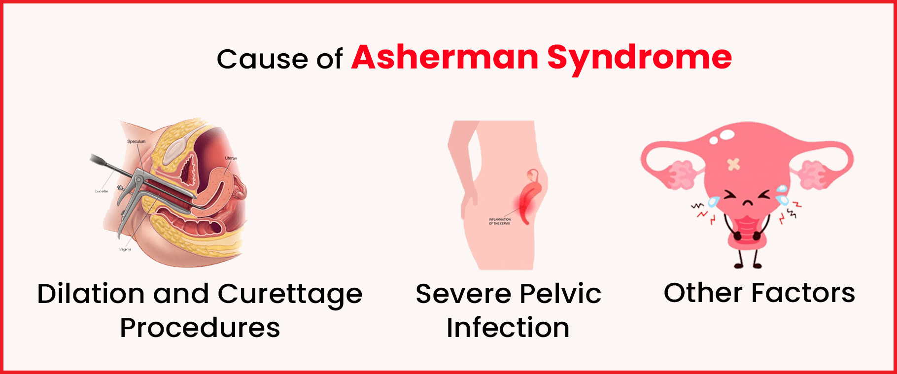 Asherman Syndrome - Causes, Symptoms, and Treatment