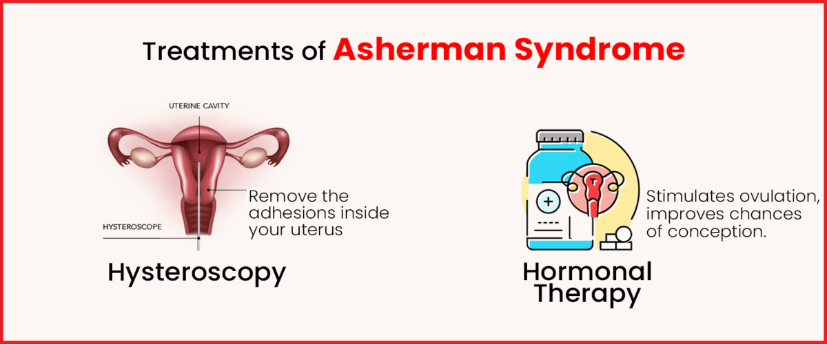 Asherman Syndrome Treatment
