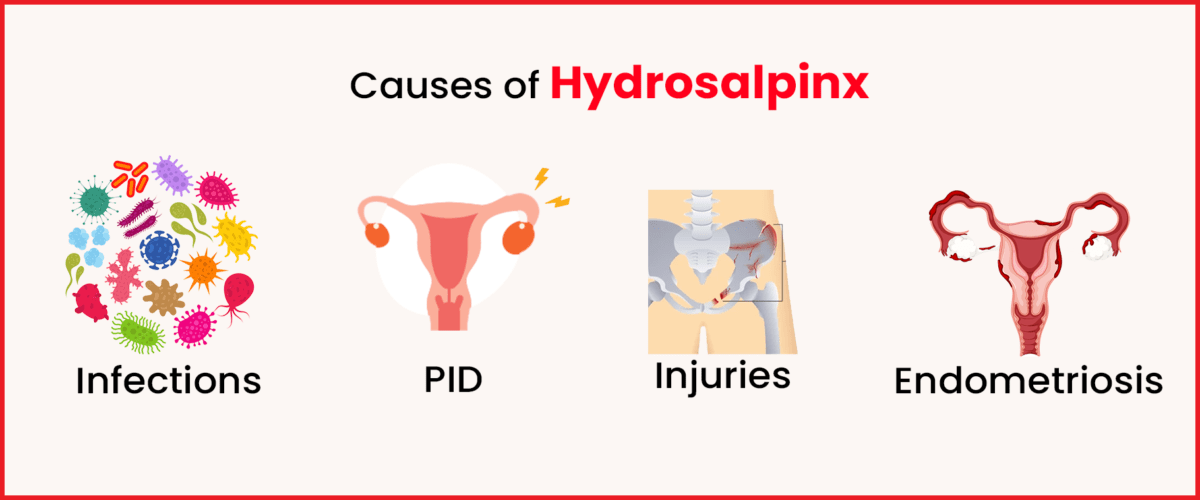 Causes of Hydrosalpinx
