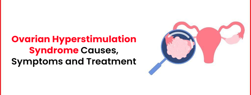 Ovarian Hyperstimulation Syndrome