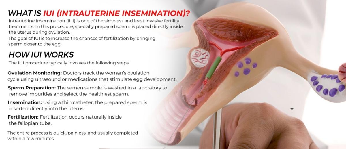 What is IUI - Infertility Treatments